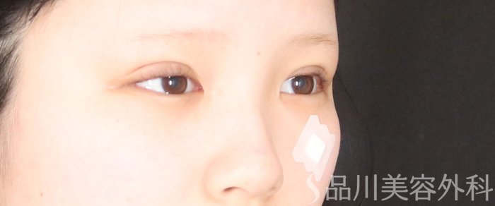 症例NO.73105のAFTER写真