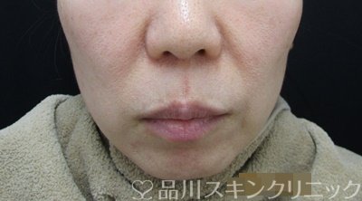 症例NO.64004のBEFORE写真