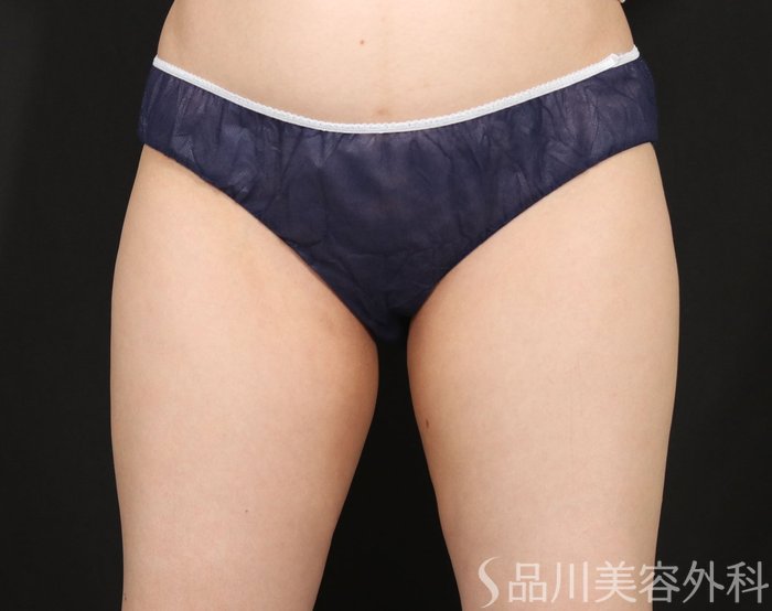 症例NO.74098のBEFORE写真