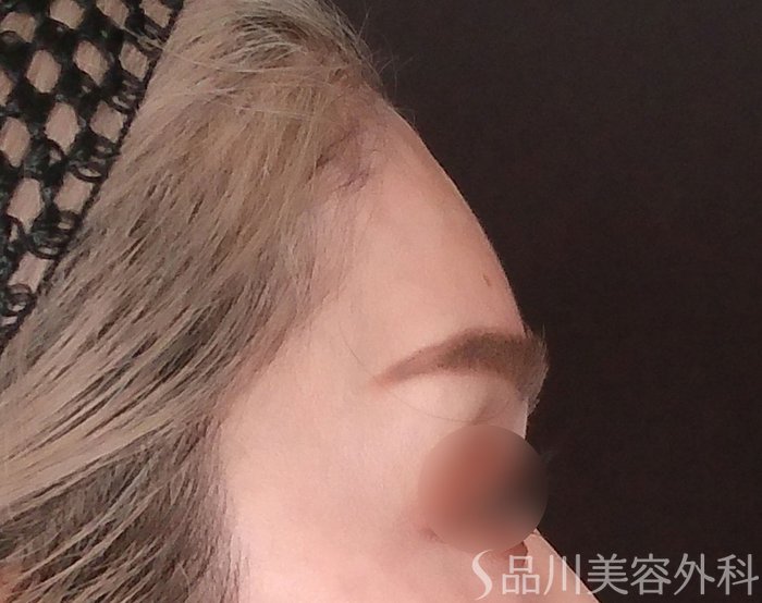 症例NO.69733のAFTER写真