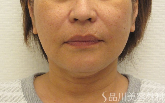 症例NO.73445のAFTER写真