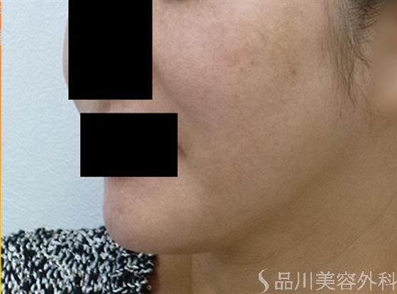 症例NO.22764のBEFORE写真