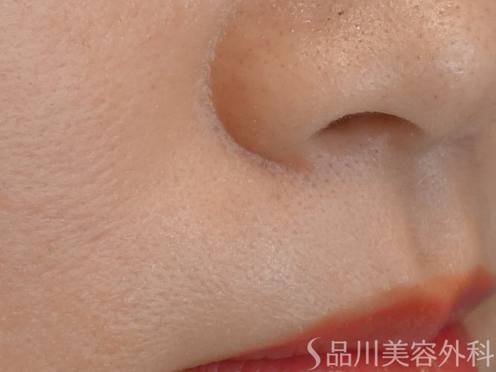 症例NO.72275のAFTER写真