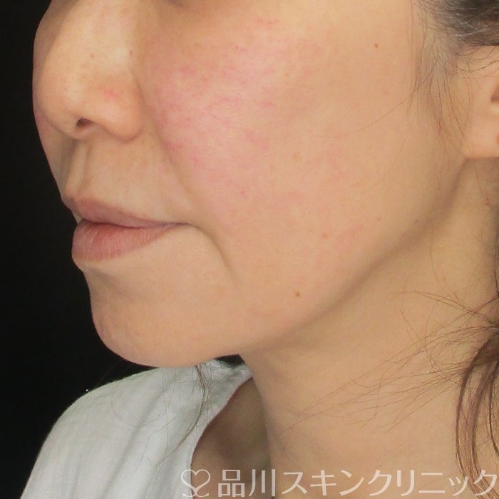 症例NO.73094のBEFORE写真