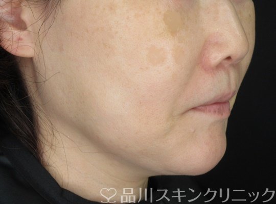 症例NO.70122のAFTER写真