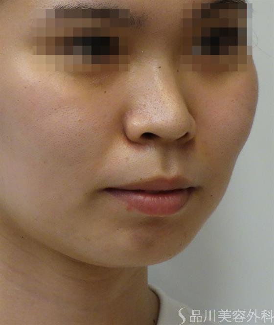 症例NO.36421のBEFORE写真