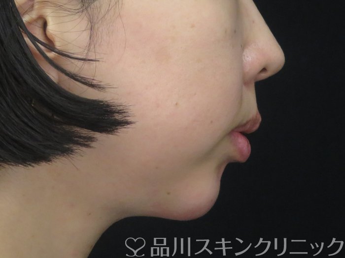 症例NO.69221のAFTER写真