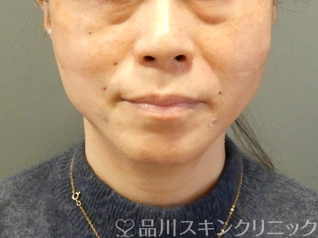 症例NO.63063のAFTER写真