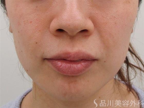 症例NO.43139のBEFORE写真