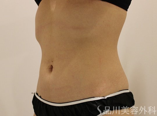 症例NO.73376のAFTER写真