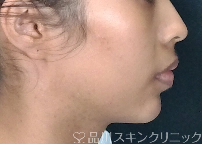 症例NO.70921のAFTER写真