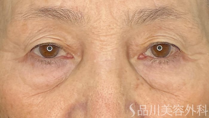 症例NO.72224のBEFORE写真