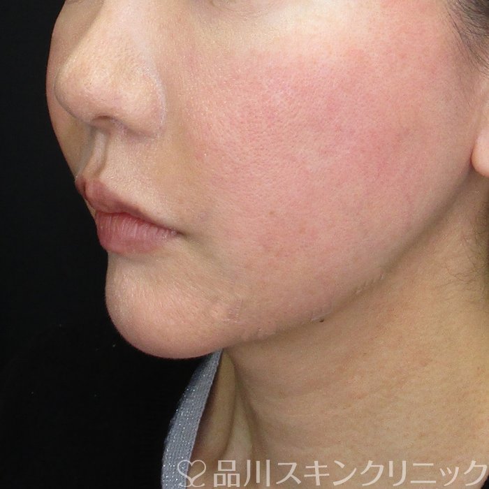 症例NO.72874のAFTER写真