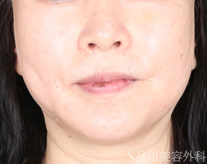 症例NO.72526のAFTER写真