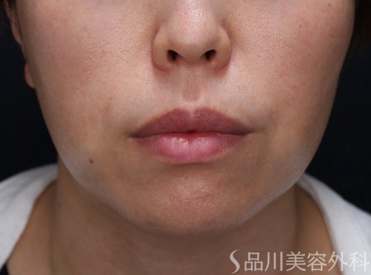 症例NO.65588のBEFORE写真
