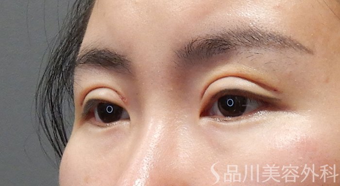症例NO.69334のAFTER写真