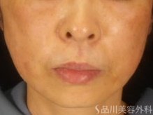 症例NO.72732のAFTER写真