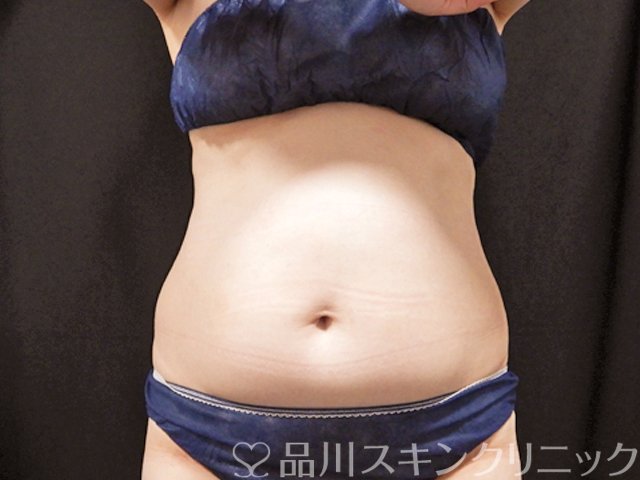 症例NO.67295のAFTER写真