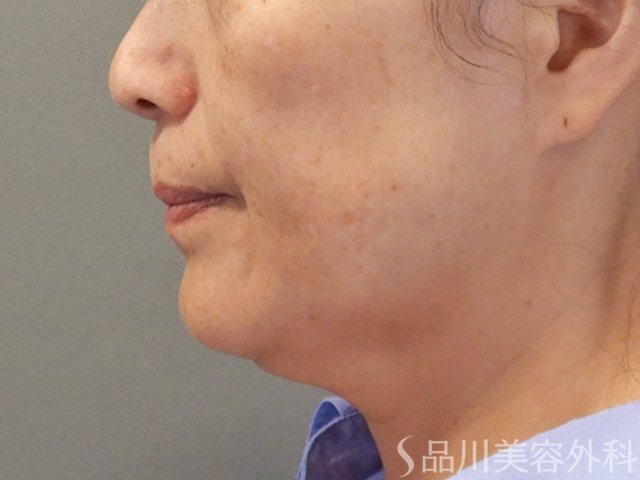 症例NO.71831のBEFORE写真