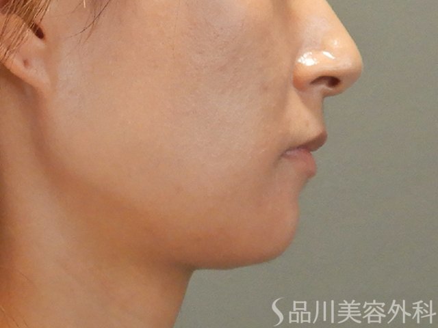 症例NO.71816のBEFORE写真