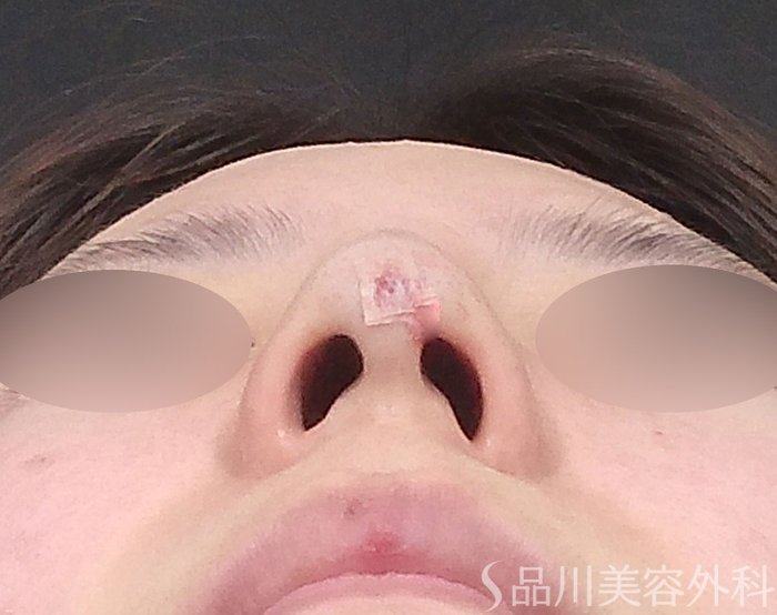 症例NO.65346のAFTER写真