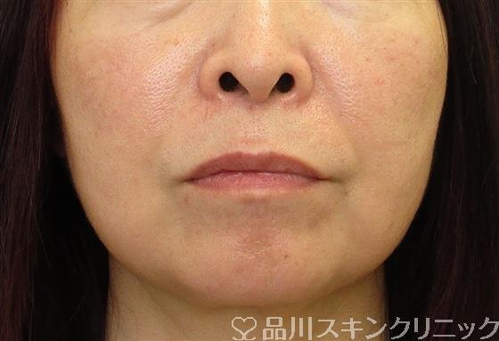 症例NO.58745のBEFORE写真