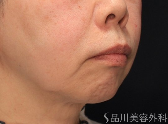 症例NO.72432のBEFORE写真