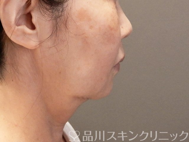 症例NO.66462のBEFORE写真
