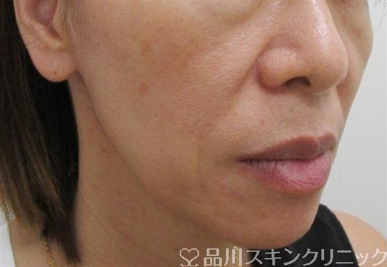 症例NO.42919のBEFORE写真