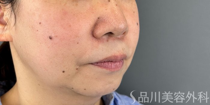 症例NO.70812のBEFORE写真