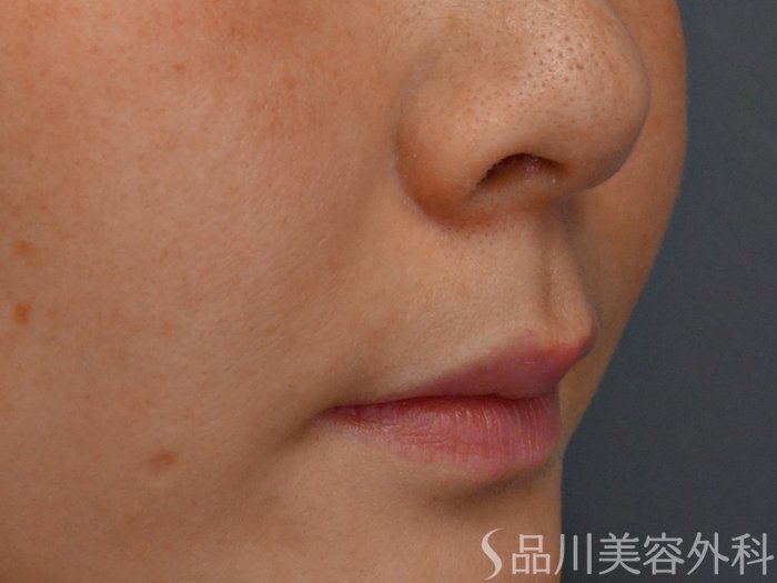 症例NO.68295のBEFORE写真