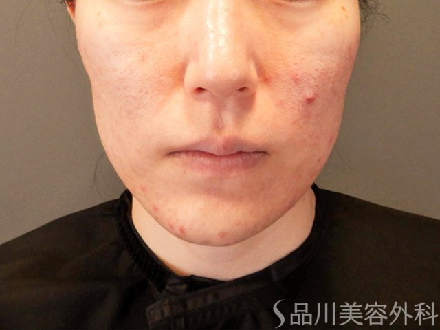 症例NO.67830のBEFORE写真