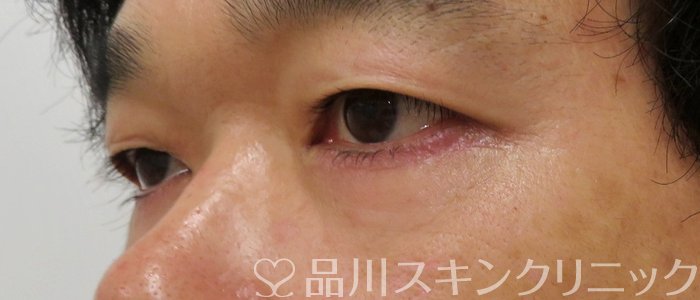 症例NO.75026のAFTER写真