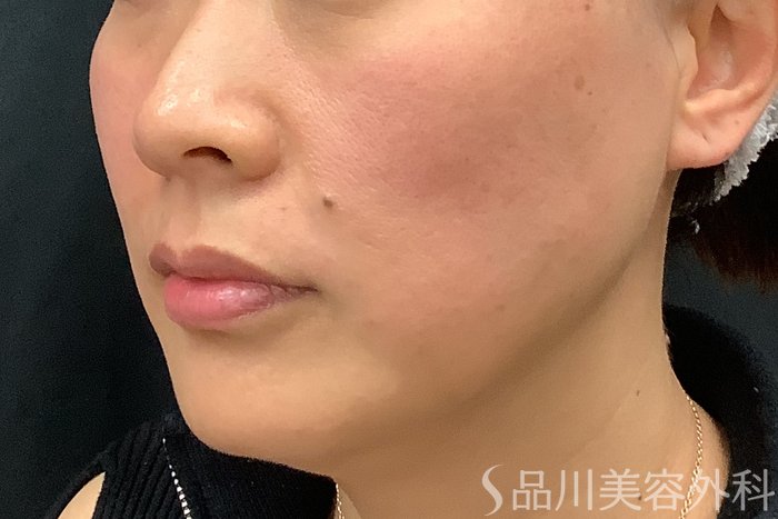 症例NO.73311のAFTER写真