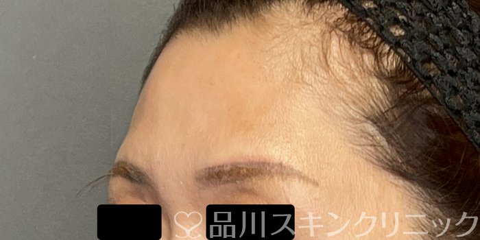 症例NO.64695のBEFORE写真