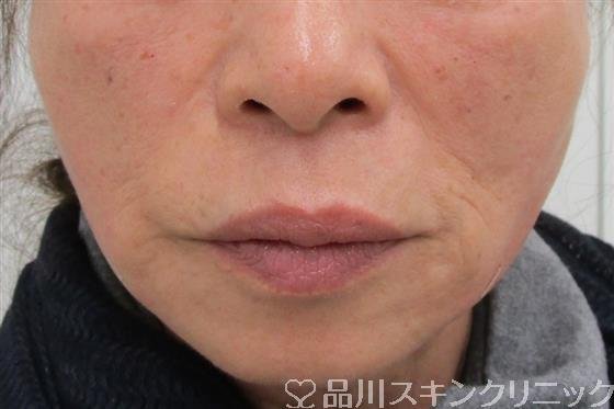 症例NO.40314のAFTER写真