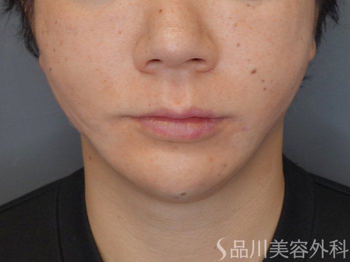 症例NO.72965のAFTER写真