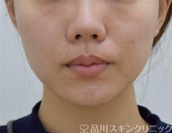 症例NO.59197のBEFORE写真