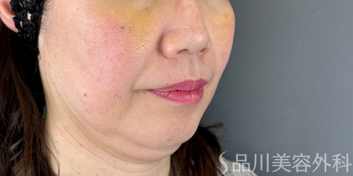 症例NO.67950のBEFORE写真