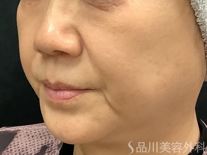 症例NO.67772のBEFORE写真