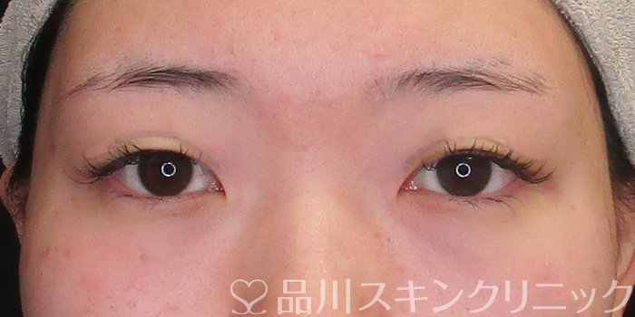 症例NO.73665のBEFORE写真