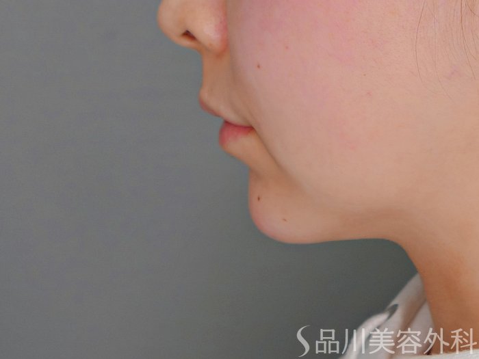 症例NO.69870のAFTER写真