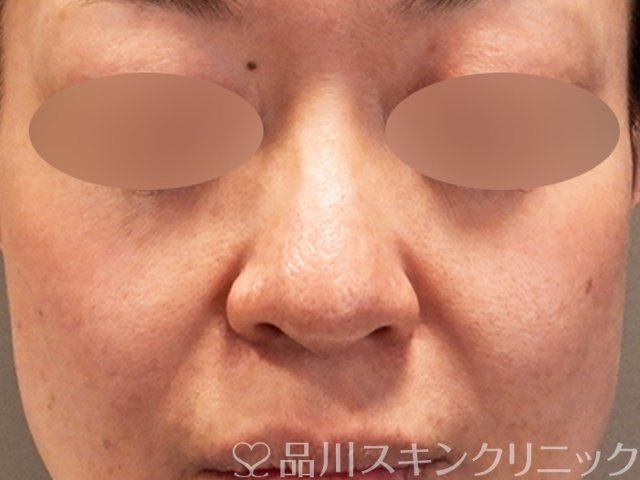 症例NO.69576のBEFORE写真