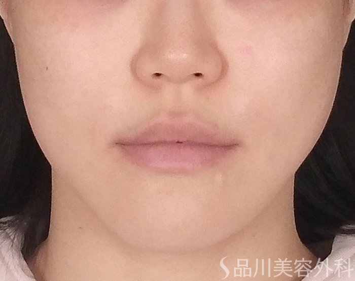 症例NO.70403のAFTER写真