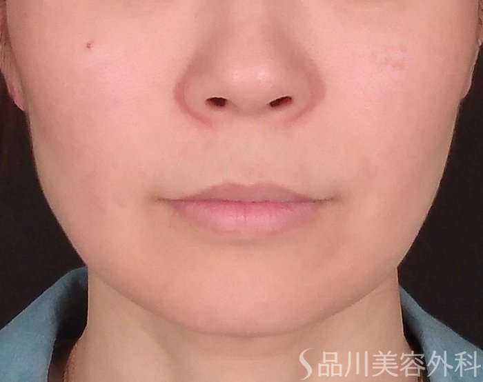 症例NO.70331のBEFORE写真