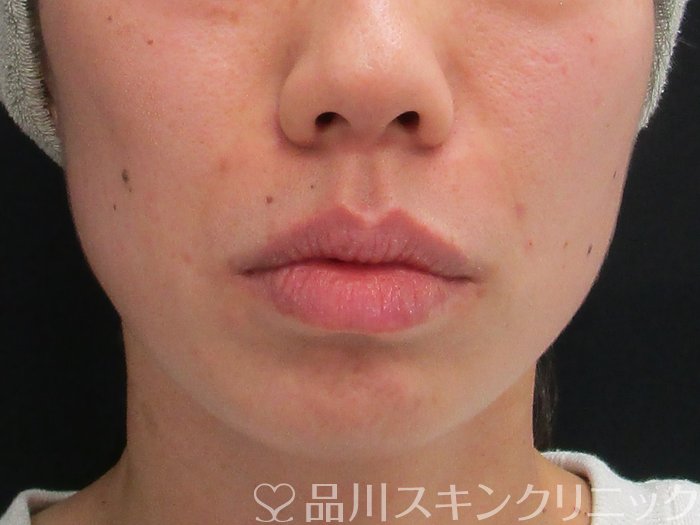 症例NO.72739のAFTER写真