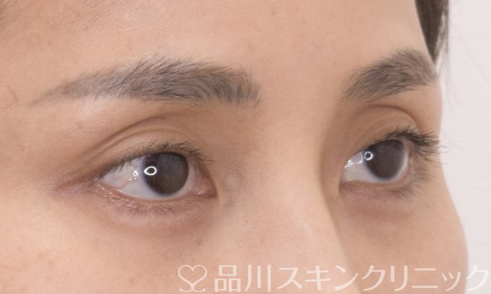 症例NO.68980のBEFORE写真