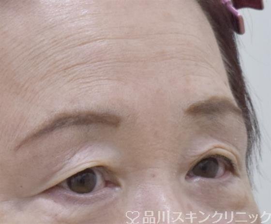 症例NO.59200のBEFORE写真