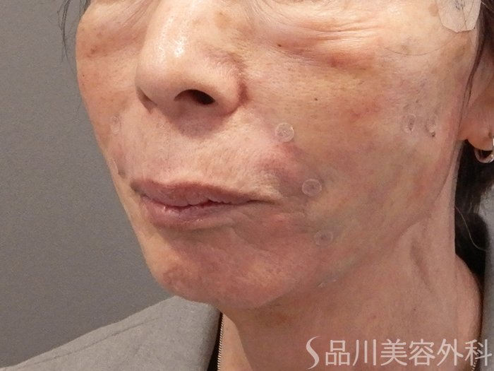 症例NO.70287のAFTER写真