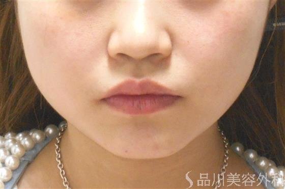 症例NO.22838のBEFORE写真